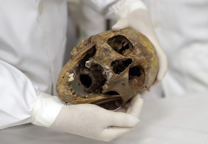 In this Dec. 7, 2016 photo, forensic doctor Daniel Munoz shows the skull of Nazi war criminal Josef Mengele, at the school of medicine of Sao Paulo University in Sao Paulo, Brazil. In an ironic twist  ...