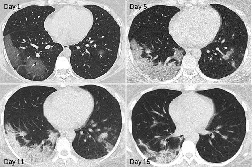 hese CT scans of a 35-year-old woman with COVID-19 pneumonia illustrate how some lung damage remains even after recovery. When she was admitted to the hospital (day 1, top left), a scan revealed tissu ...