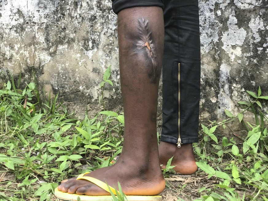 In this Tuesday, Aug. 29, 2017 photo made available by UNICEF, a boy displays a scar from a wound he obtained during his time in the militia, in Mbuji Mayi, Kasai province, Democratic Republic of the  ...