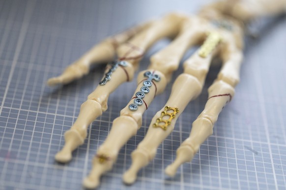 ZUM MEDIZINALTECHNIKUNTERNEHMEN MEDARTIS STELLEN WIR IHNEN FOLGENDES NEUES BILDMATERIAL ZUR VERFUEGUNG --- Fixation plates are affixed on an artificial hand bone structure to demonstrate how the fixat ...