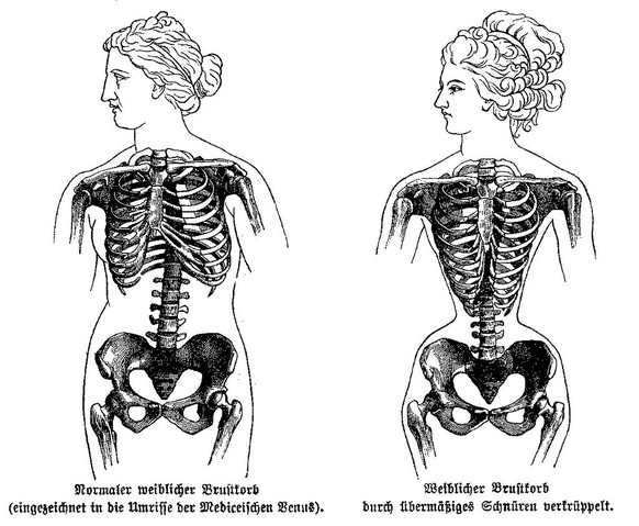 1892, verkrüppelung des weiblichen brustkastens durch zu enges schnüren. Wespentaille