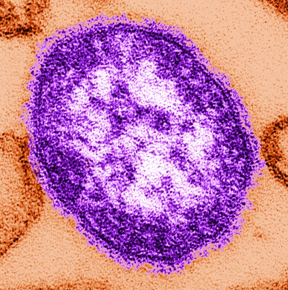 This undated image made available by the Centers for Disease Control and Prevention on Feb. 4, 2015 shows an electron microscope image of a measles virus particle, center. Measles is considered one of ...