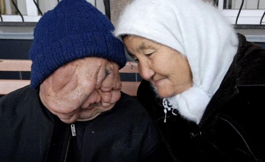 Kasachstan, Opfer der durch die sowjetischen Atomversuche in Semipalatinsk verursachten Strahlenbelastung