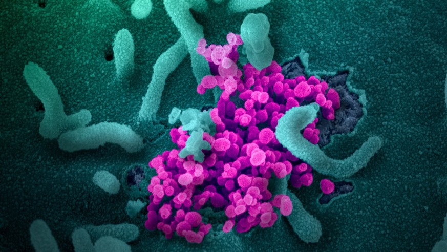 epa08252654 An undated handout picture made available by the National Institutes of Health (NIH) shows a scanning electron microscope image of SARS-CoV-2 (round magenta objects) emerging from the surf ...