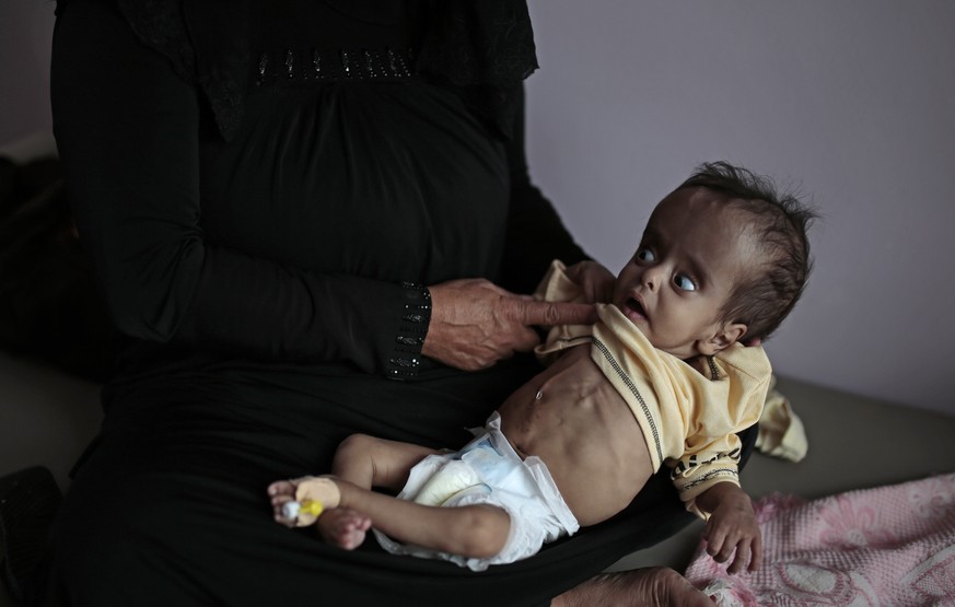 A woman holds her malnourished boy at a feeding center at Al-Sabeen hospital in Sanaa, Yemen, Saturday, June 27, 2020. (AP Photo/Hani Mohammed)