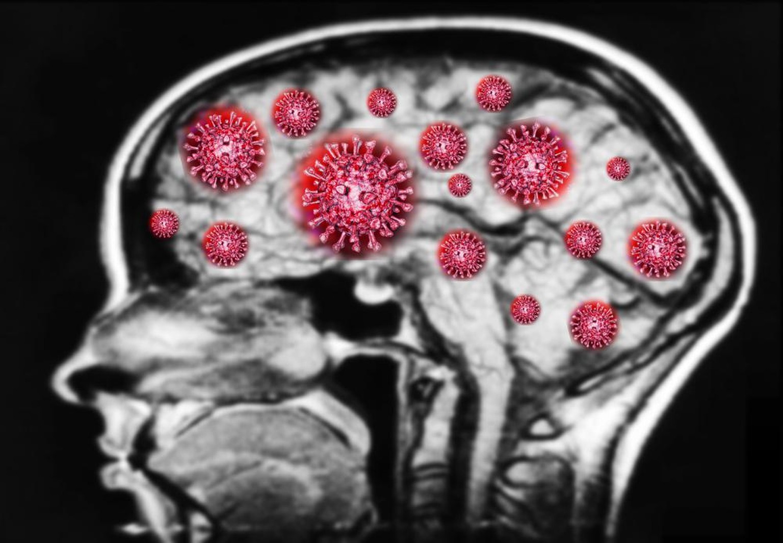 SARS-CoV-2, Covid-19, Coronavirus, Gehirn (Symbolbild)