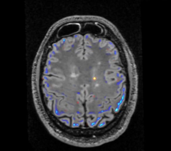 Das Bild zeigt in Gelb/Orange einen von der KI-Software markierten neuen Plaque (Narbenbildung) bei einem jungen Mann mit Multipler Sklerose. In Blau werden Unterschiede vom aktuellen zum früheren MRI ...