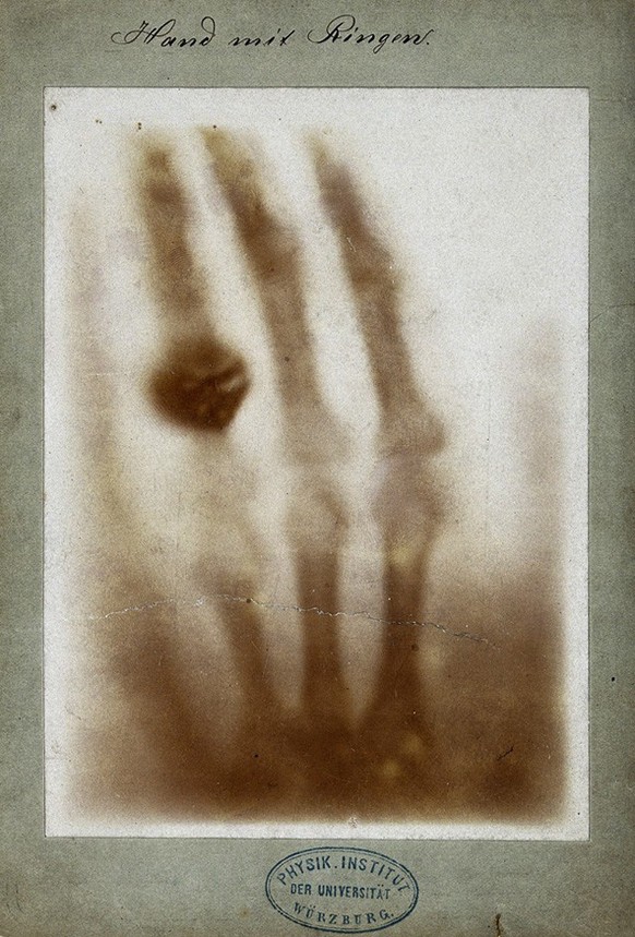 Berthas Hand mit Ringen – das erste Röntgenbild von Wilhelm Conrad Röntgen in seinem Laboratorium im Physikalischen Institut der Universität Würzburg gemacht, 1895.