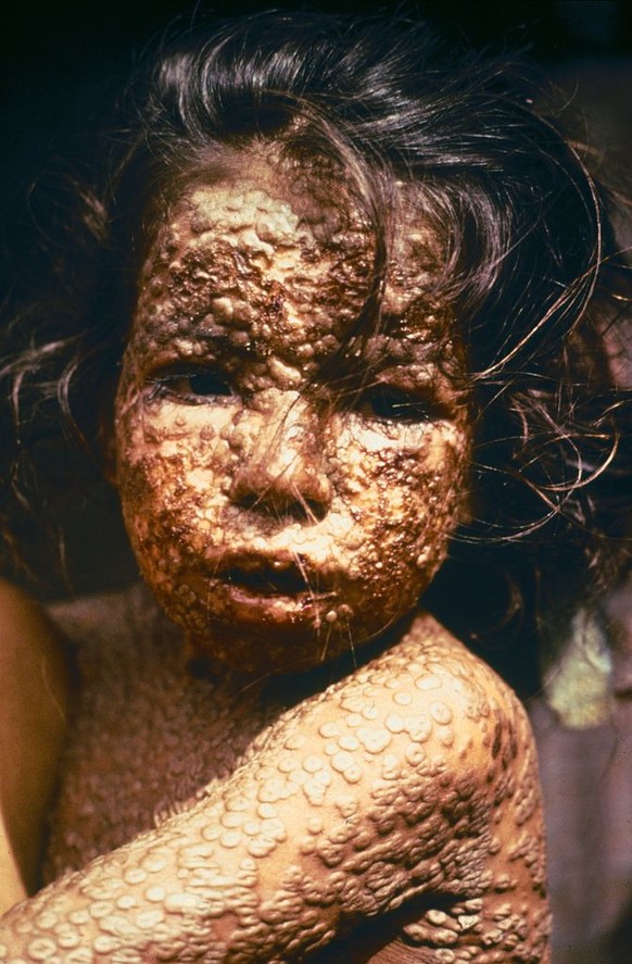 Ein junges Mädchen in Bangladesh 1973, infiziert mit Pocken. Im Dezember 1977 wurde Bangladesh für pockenfrei erklärt
https://upload.wikimedia.org/wikipedia/commons/thumb/6/66/Child_with_Smallpox_Bang ...
