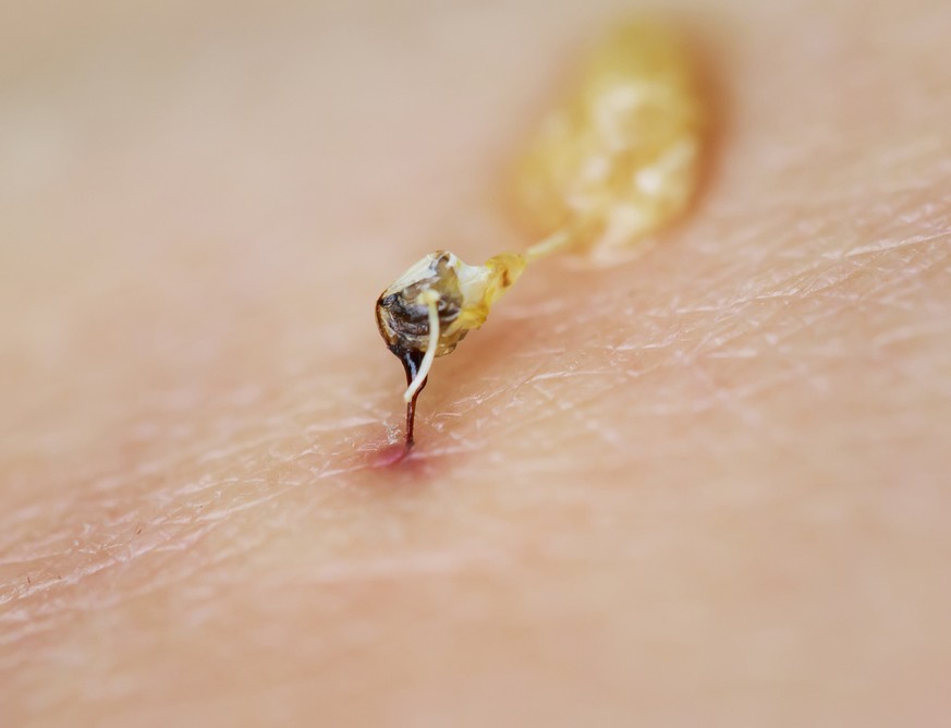 Der Stachel bleibt stecken und der Stechapparat mit Giftblase bleibt zurück, nachdem die Biene in menschliche Haut gestochen hat.