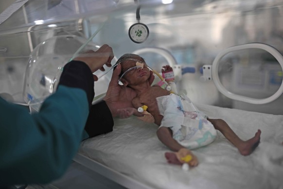 FILE - In this June 27, 2020 file photo, a medic checks a malnourished newborn baby inside an incubator at Al-Sabeen hospital in Sanaa, Yemen. Human Rights Watch warned Monday, Sept. 14, 2020 that war ...