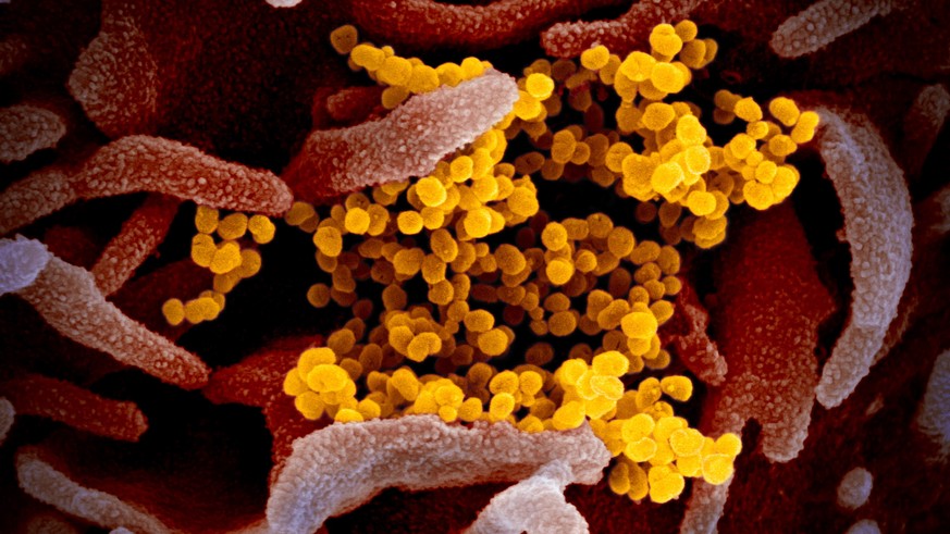 epa08252655 An undated handout picture made available by the National Institutes of Health (NIH) shows a scanning electron microscope image of SARS-CoV-2 (yellow) -- also known as 2019-nCoV, the virus ...