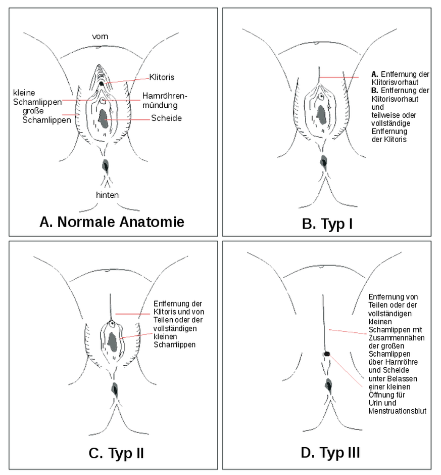 Typ I bis III der weiblichen Genitalverstümmelung.