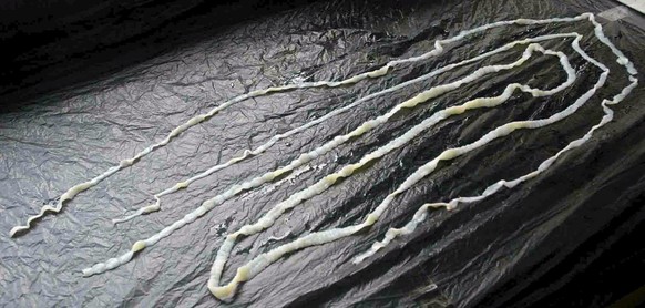 Described as the longest in the medical history of Sri Lanka, this tapeworm measuring 15 feet (5 metres) was found in the abdomen of a foreign national living in the country, Colombo, Monday 11 July 2 ...