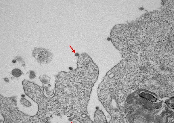 epa08339346 An undated handout picture made available by the Clinical Pathology Lab of the Department of Biomedical Sciences for Health (SCIBIS) at the University of Milan shows an arrow pointing to a ...
