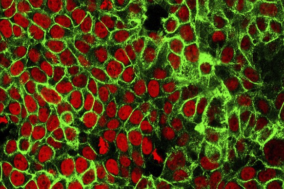 This microscope image made available by the National Cancer Institute Center for Cancer Research in 2015 shows human colon cancer cells with the nuclei stained red. On Friday, May 29, 2020, doctors ar ...