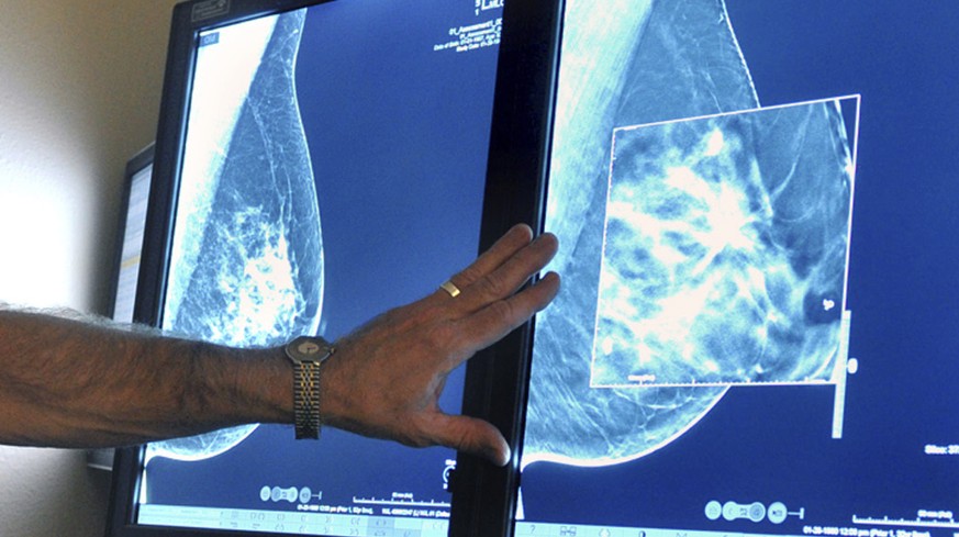 FILE - In this July 31, 2012 file photo, a radiologist compares an image from earlier, 2-D technology mammogram to the new 3-D Digital Breast Tomosynthesis mammography in Wichita Falls, Texas. Two lar ...