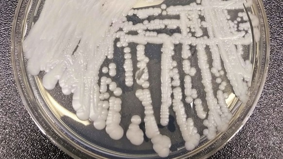 This undated photo made available by the Centers for Disease Control and Prevention shows a strain of Candida auris cultured in a petri dish at a CDC laboratory. On Tuesday, April 25, 2017, New York s ...