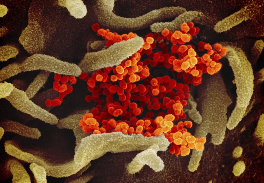 This undated electron microscope image made available by the U.S. National Institutes of Health in February 2020 shows the Novel Coronavirus SARS-CoV-2, orange, emerging from the surface of cells, gre ...