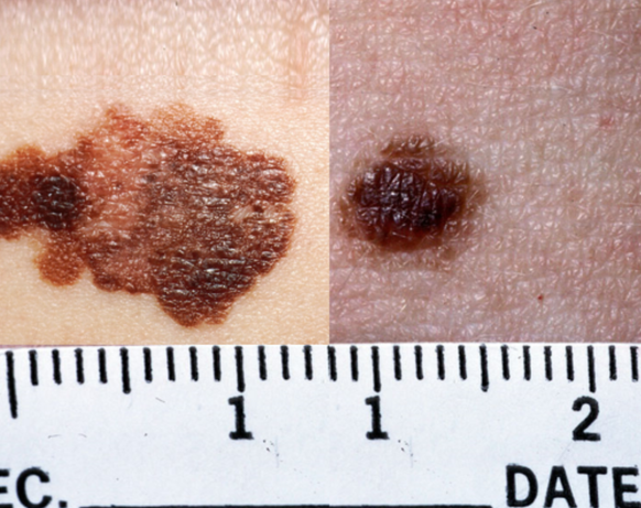 Welches Bild zeigt ein Muttermal und welches den schwarzen Hautkrebs? KI wüsste die Antwort (Auflösung unten am Ende des Artikels).