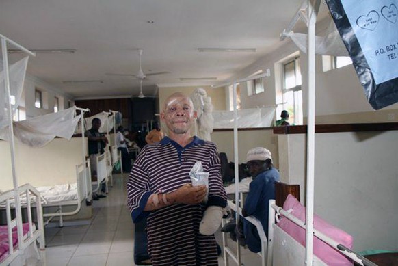 Immer wieder Opfer von Gewalt: Albinos in Tansania.